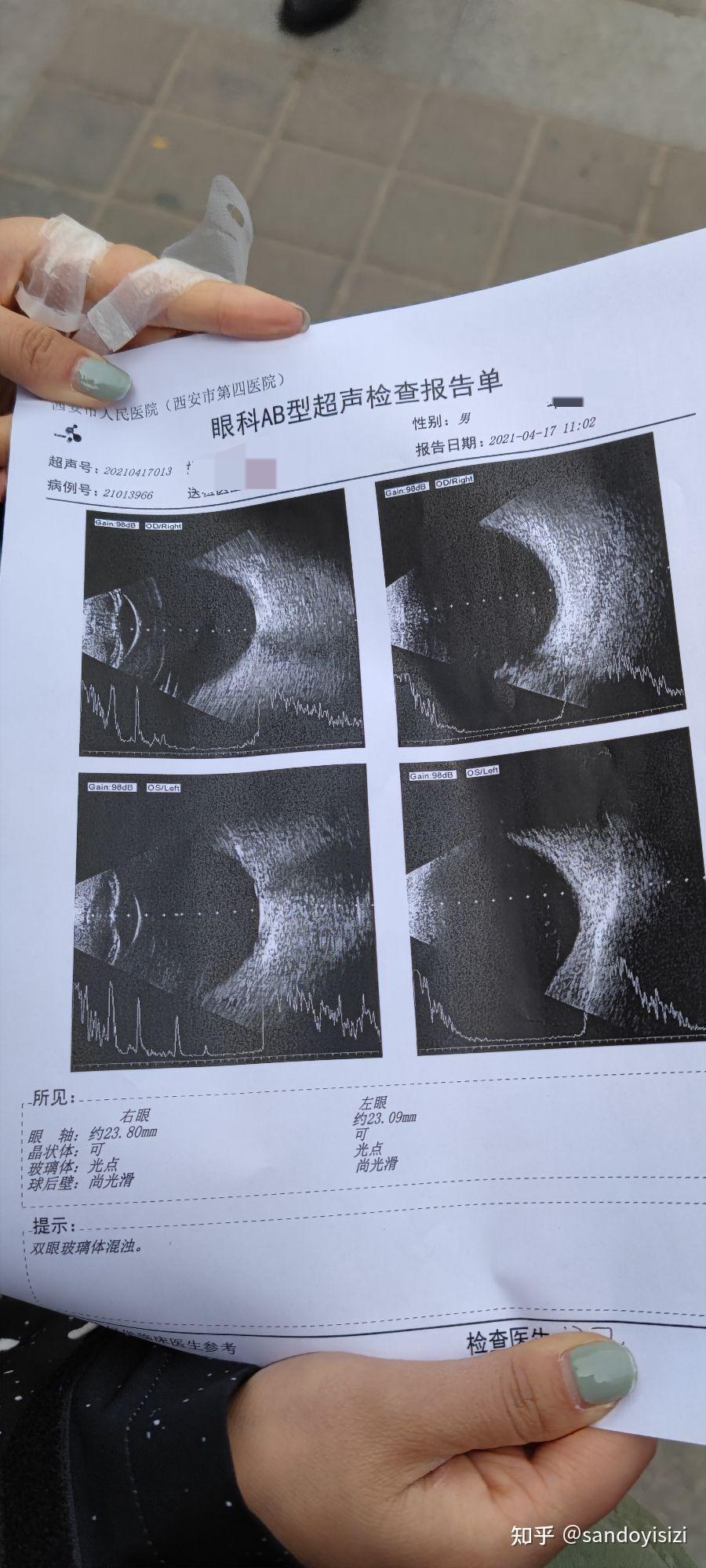 玻璃体混浊最新特效药