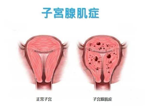 腺肌症的最新疗法,突破性疗法引领腺肌症治疗新篇章