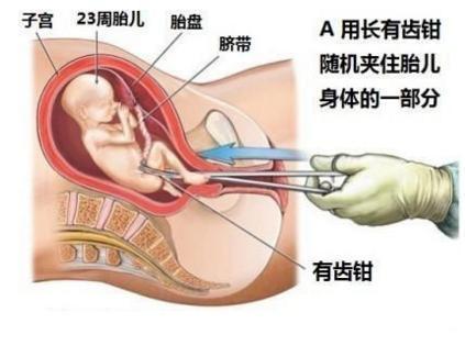 最新药流,“近期流产新法”